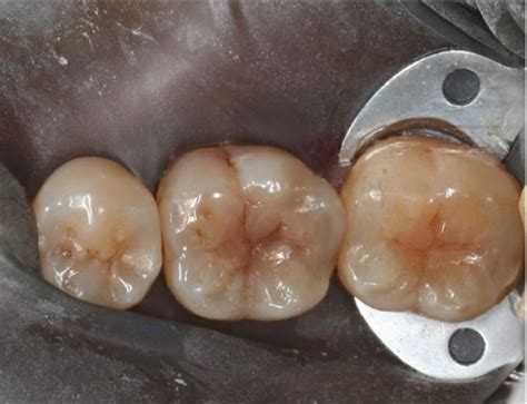 Restoring proximal caries lesions conservatively with tunnel .